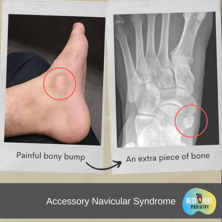 Accessory navicular syndrome 시드니 좋은 발병원