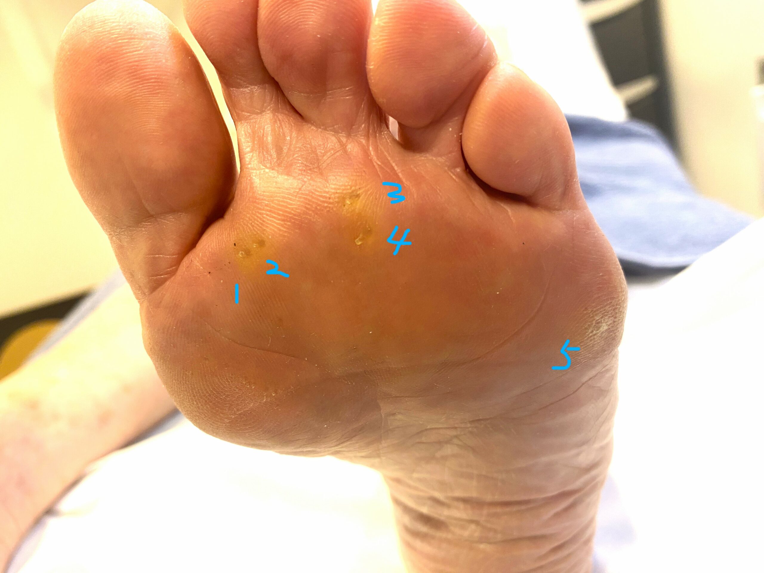 발바닥 티눈 IPK intractable plantar keratoma 제거 시드니 좋은 발병원